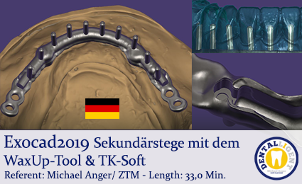 Product image 1 of the product “Exocad2019  -Sekundärstege mit dem WaxUp-Tool & TK-Soft ”