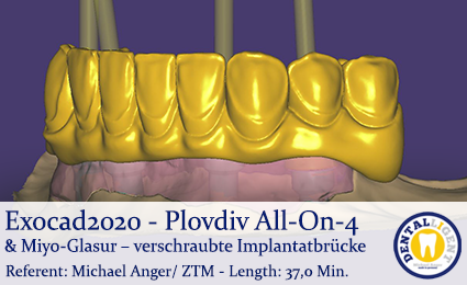 Artikelbild 1 des Artikels “2020-Exocad - Exocad Plovdiv - All-On-4 & Miyo-Glasur – verschraubte Implantatbrücke “