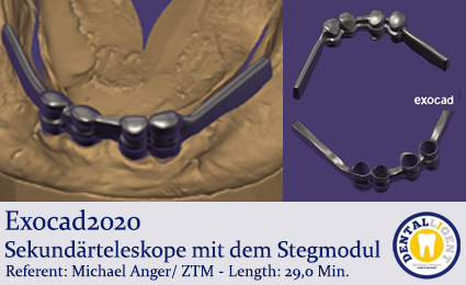 Artikelbild 1 des Artikels “2020-Exocad - Sekundärteleskope mit dem Stegmodul “