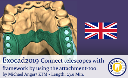 Product image 1 of the product “Exocad2019  - Connect telescopes with framework by using the attachment-tool ”