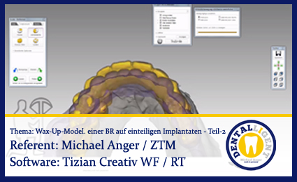 Product image 1 of the product “Wax-Up-Modellation einer Brücke auf einteiligen Implantaten - Teil 2 ”
