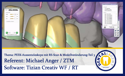 Product image 1 of the product “PEEK-Aussenteleskope mit Renishaw-Scan & Modellveränderung - Teil 3 ”