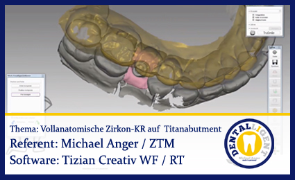 Product image 1 of the product “Modellation einer vollanatomischen Zirkonkrone auf einem Titanabutment ”