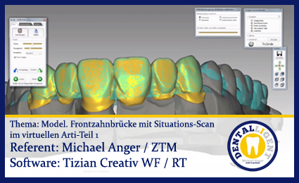 Product image 1 of the product “Modellation einer Frontzahnbrücke mit Situations-Scan im virtuellen Arti - Teil 1 ”