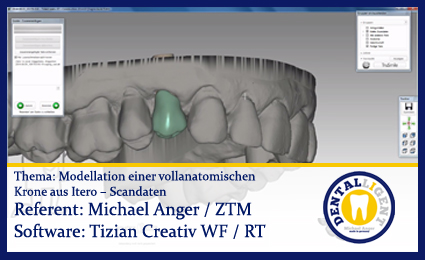 Product image 1 of the product “Modellation einer vollanatomischen  Krone aus Itero – Scandaten ”