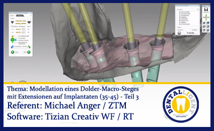 Artikelbild 1 des Artikels “Modellation eines Dolder-Macro-Steges  mit Extensionen auf Implantaten (35-45) Teil 3 “