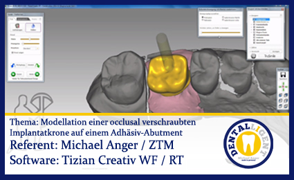 Artikelbild 1 des Artikels “Modellation einer occlusal verschraubten Implantatkrone auf einem Adhäsiv-Abutment “