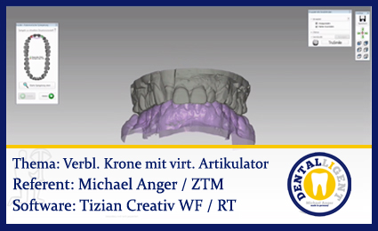 Product image 1 of the product “Modellation einer vestibulär verblendeten Krone mit virtuellem Artikulator ”