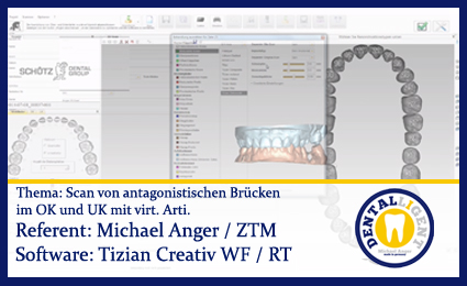 Artikelbild 1 des Artikels “Scan von antagonistischen Brücken im OK und UK mit virt. Arti. “