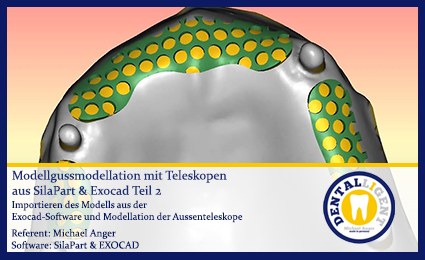 Product image 1 of the product “Modellgussmodellation mit Teleskopen aus SilaPart & Exocad Teil 1 ”
