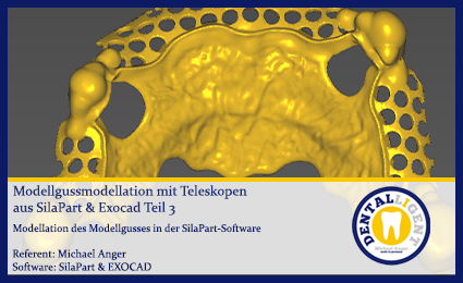 Artikelbild 1 des Artikels “Modellgussmodellation mit Teleskopen aus SilaPart & Exocad Teil 3 “