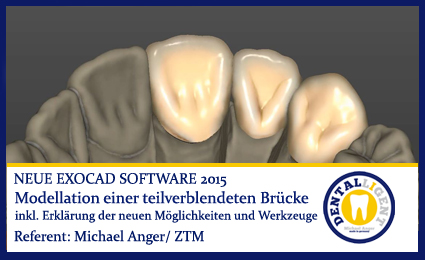 Artikelbild 1 des Artikels “2015-Modellation einer teilverblendeten Brücke - Exocad 2015 “