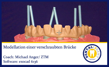 Product image 1 of the product “exocad - Modellation einer verschraubten Brücke ”