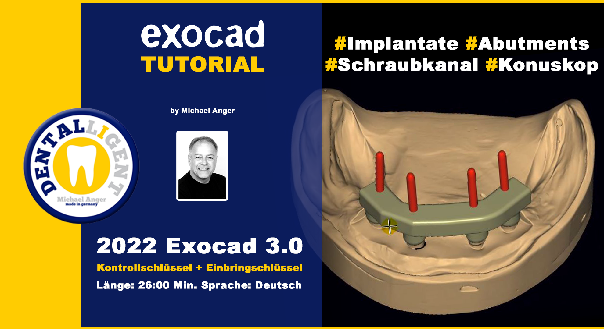 Product image 1 of the product “2022-Exocad 3.0 – Kontrollschlüssel + Einbringschlüsse ”