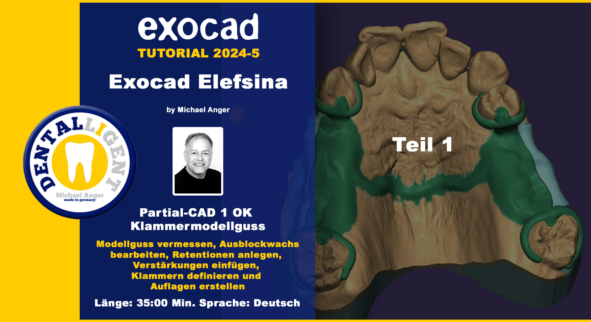 Artikelbild 1 des Artikels “Exocad Elefsina 2024-5 Partial-CAD 1 OK Klammermodellguss Teil 1 “