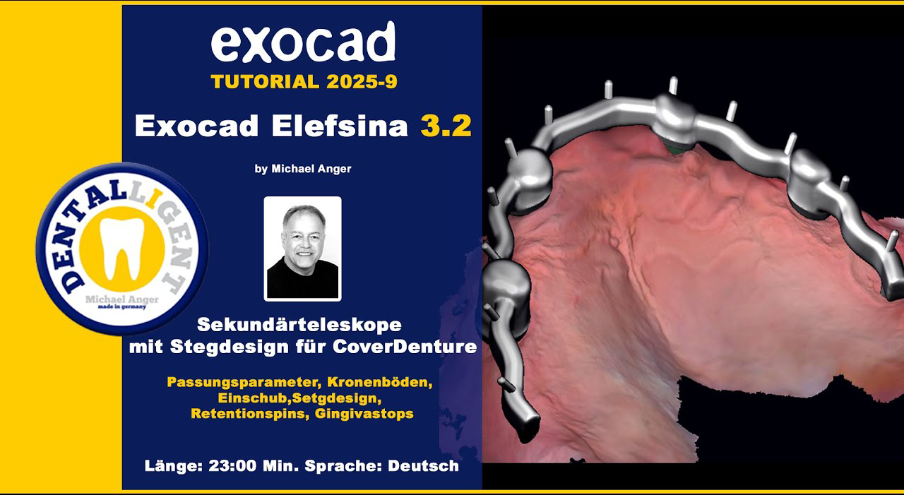 Artikelbild 1 des Artikels “Exocad Elefsina 3.2 - 2025-9 - Sekundärteleskope mit Stegdesign für CoverDenture “