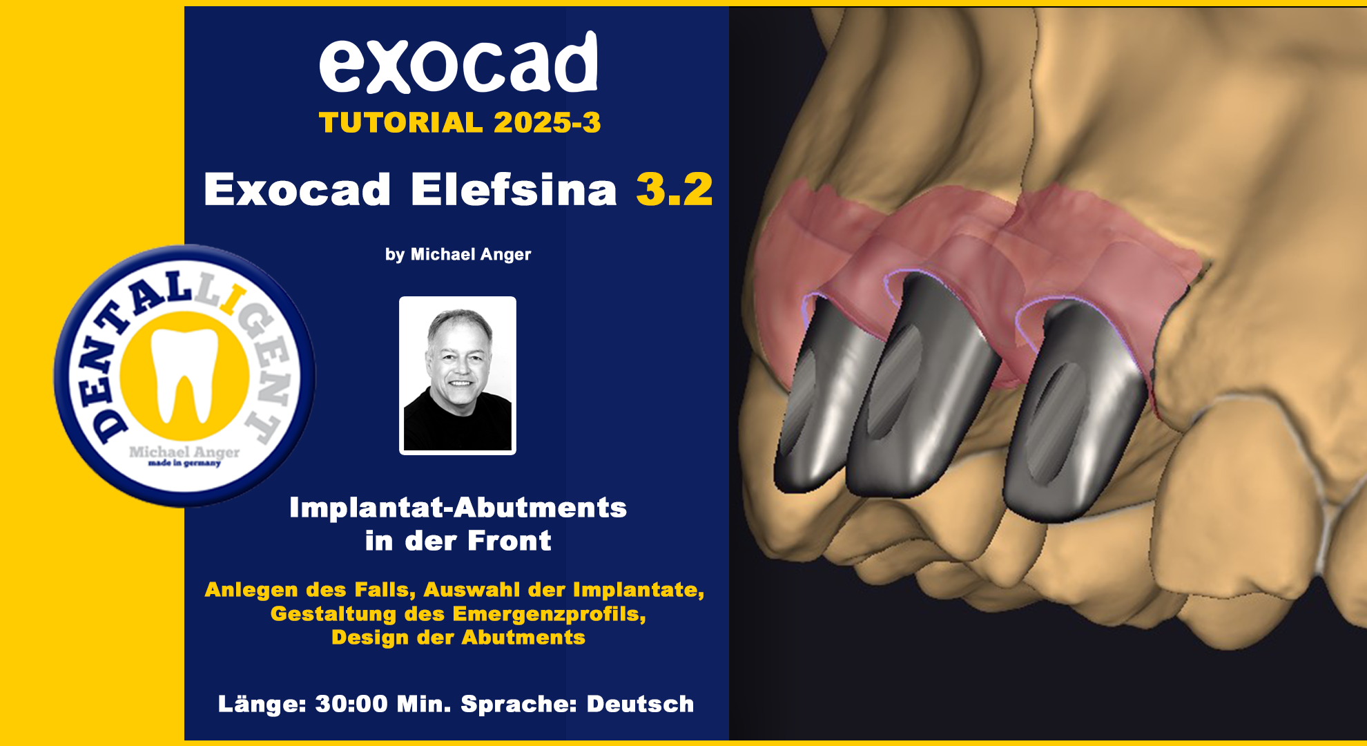 Product image 1 of the product “Exocad Elefsina 3.2 - 2025-2 - Teleskope + skelettierter Modellguss im Stegdesign TEIL 2 ”