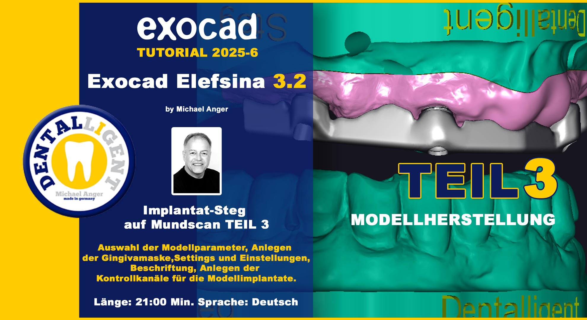 Artikelbild 1 des Artikels “Exocad Elefsina 3.2 - 2025-6 - Implantat Steg auf Mundscan Teil 3 “