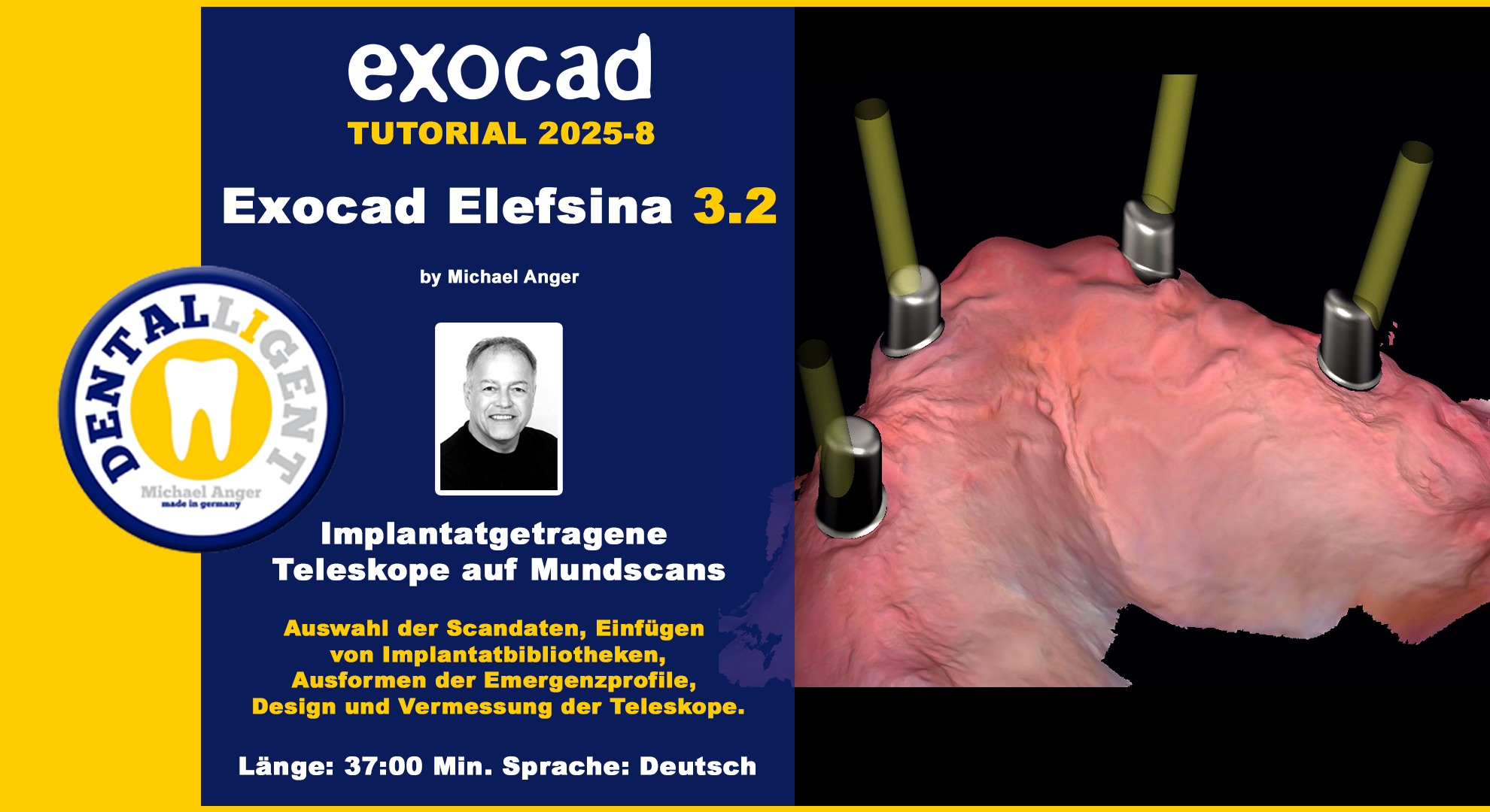 Product image 1 of the product “Exocad Elefsina 3.2 - 2025-8 --Implantatgetragene Teleskope auf Mundscan ”