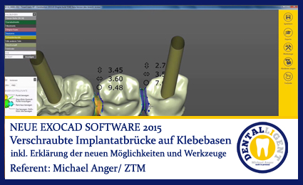 Product image 1 of the product “2015-Verschraubte Implantatbrücke auf Klebebasen - Exocad 2015 ”