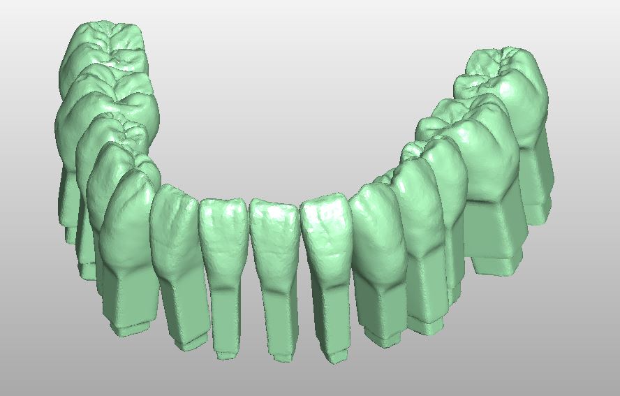 Product image 4 of the product “STL-FILES +  LIBRARY  - Upper jaw-MODELL with PIN- LIBRARY  for exocad by M. Anger ”